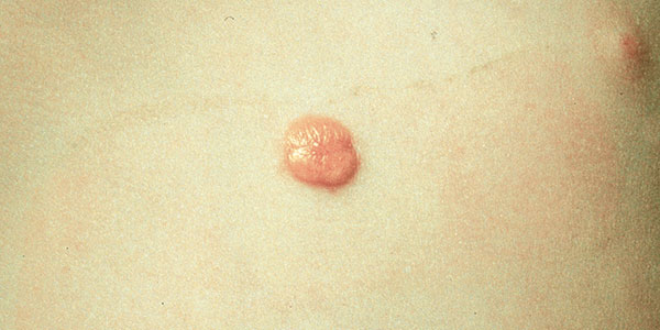 Figure 1. Typical bright yellow-orange juvenile xanthogranuloma on chest.