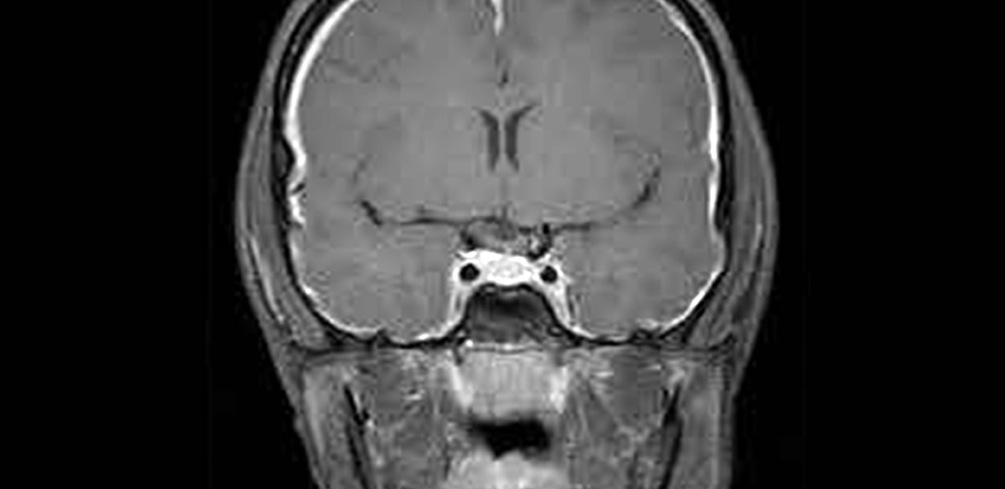 Figure 1. Coronal post-contrast MRI brain