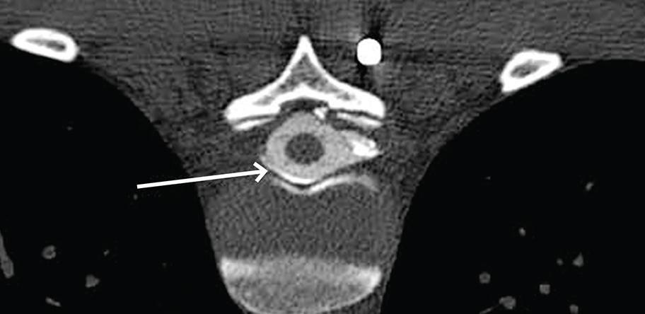 Fig3.CT myelogram demonstrating a moderate lea