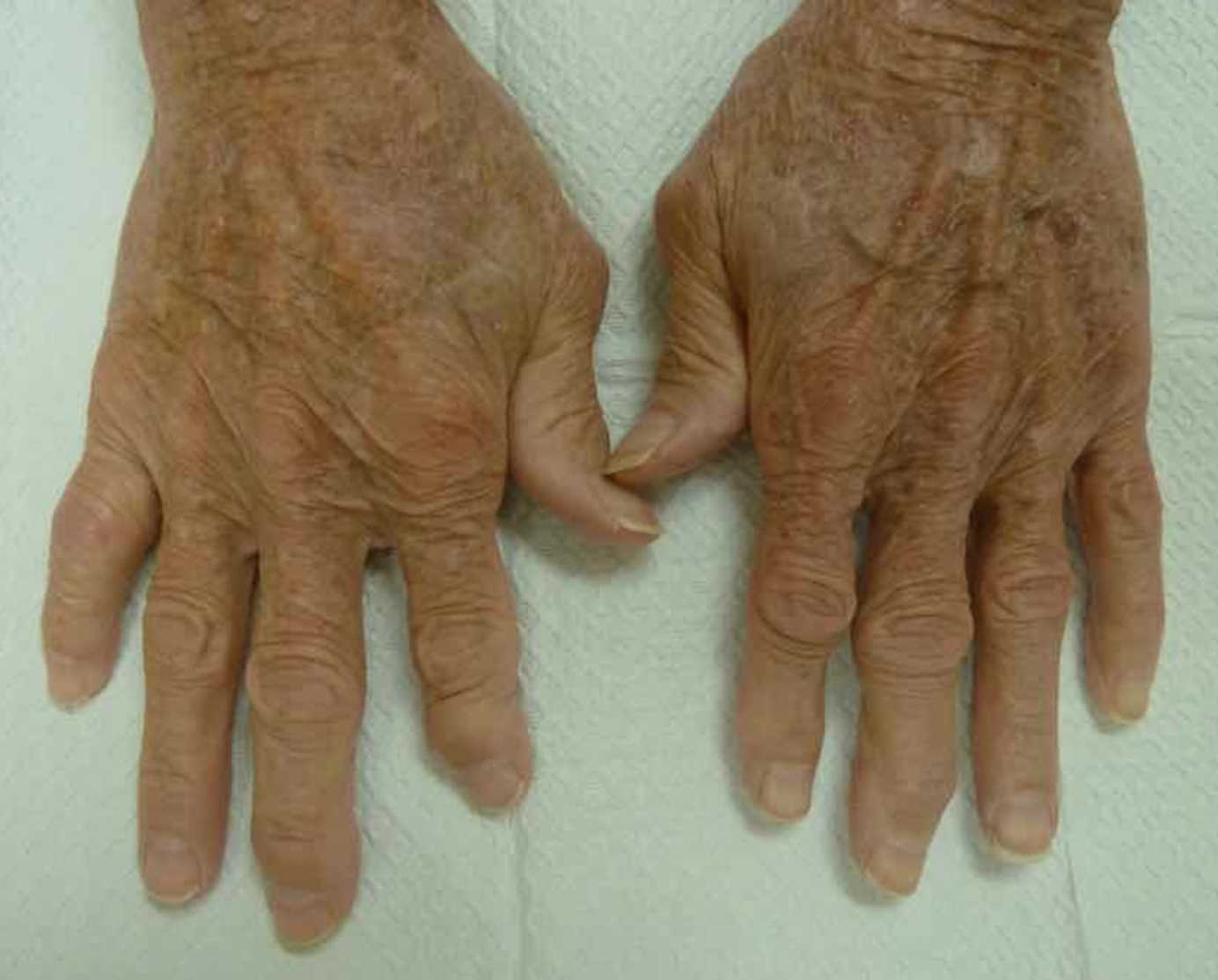 arthritis