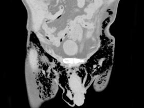 CT abdomen pelvis