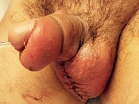 Scrotal wound and penile oedema
