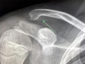 Sleeve fracture