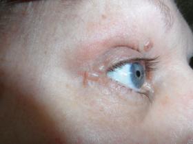 Eyelid lumps and bumps | Australian Doctor Group