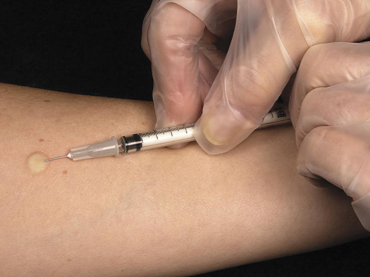 Cover-Mantoux tuberculin skin test