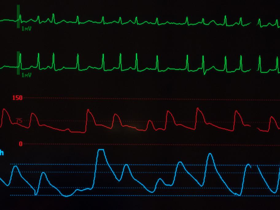 atrial fibrillation