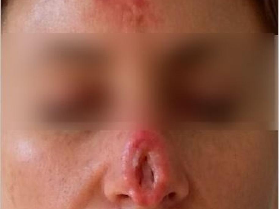 black salve damage