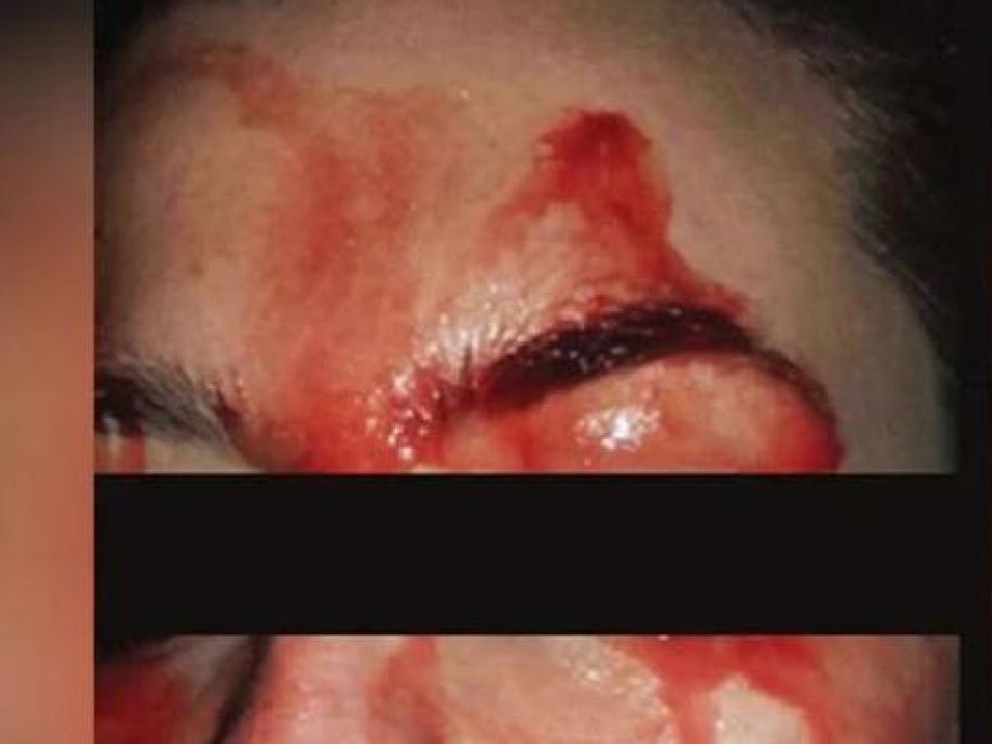 hematohidrosis