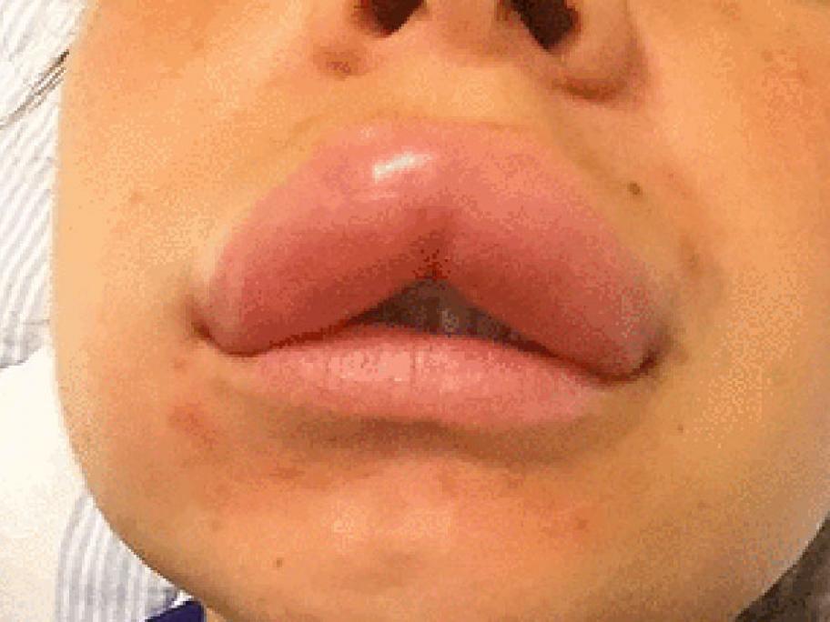 Angioedema