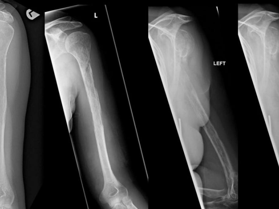 Vanishing bone disease