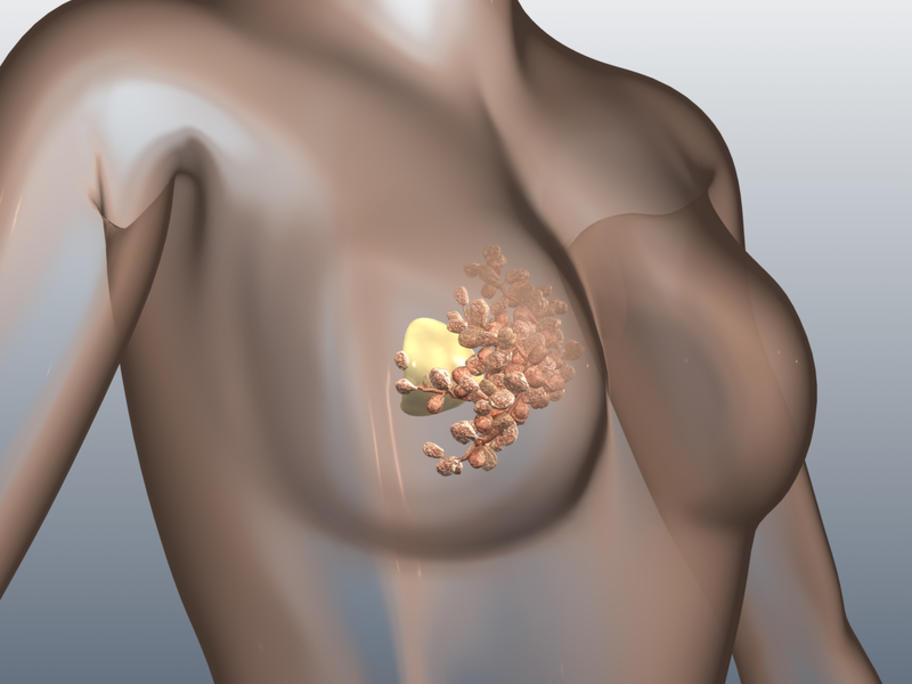 breast cancer diagnosis