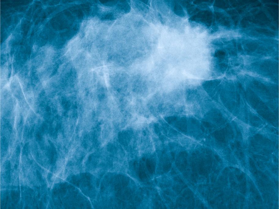 breast mri