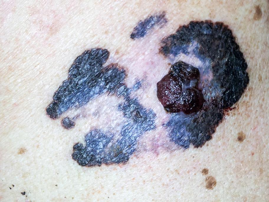 melanoma