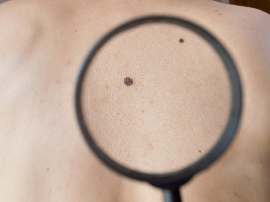 melanoma