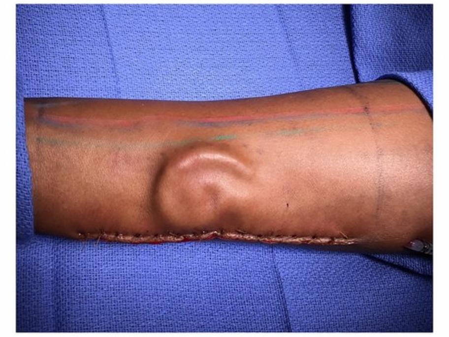 ear transplant plastic surgery