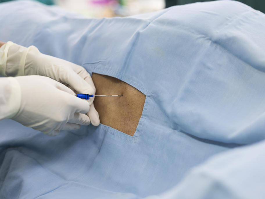 epidural