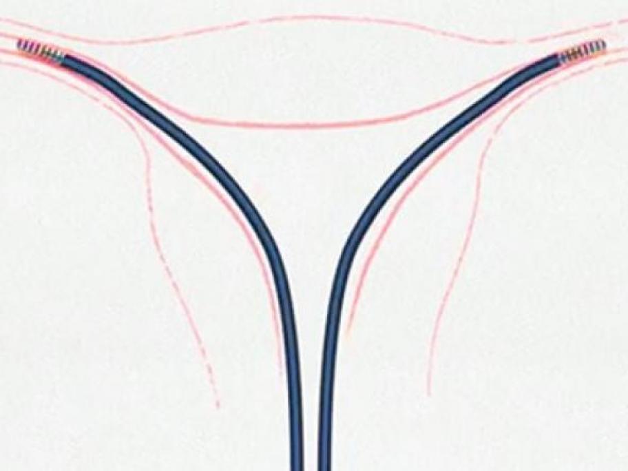 Essure