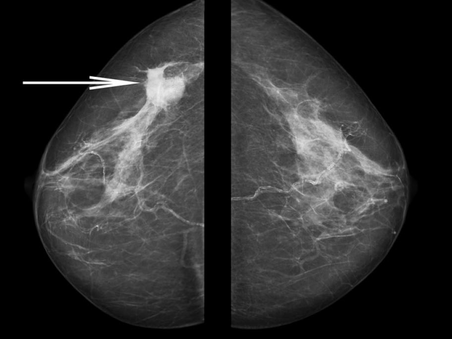 mammogram showing cancer
