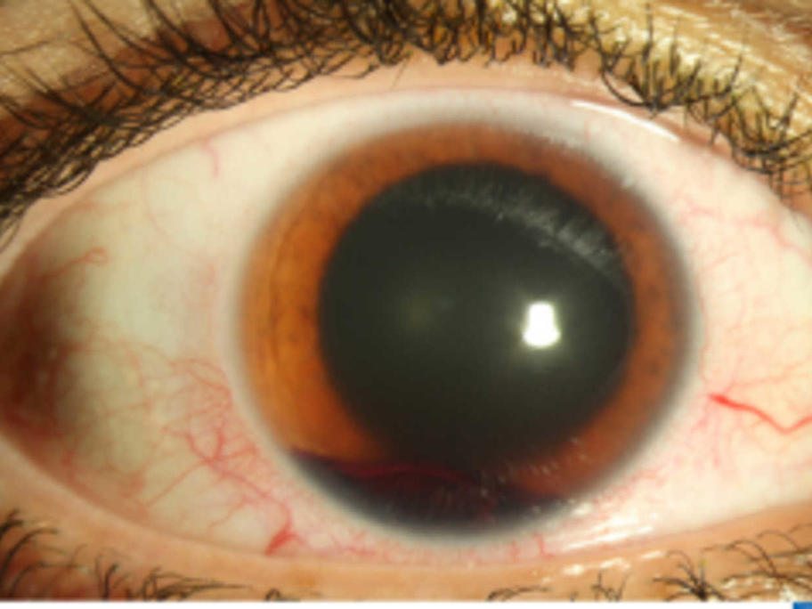 Nerf gun eye injury