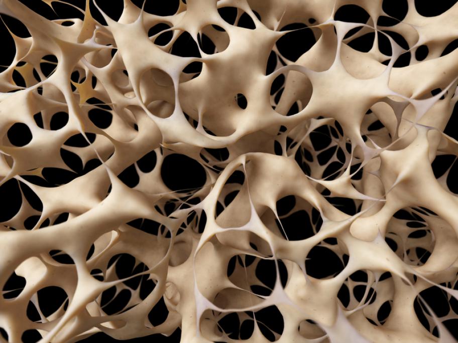 Osteoporosis illustration
