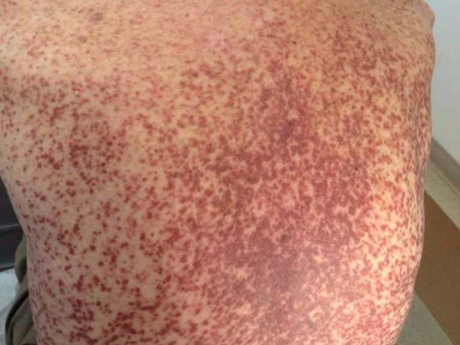rash on back