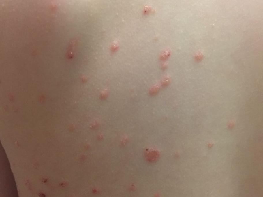 rash