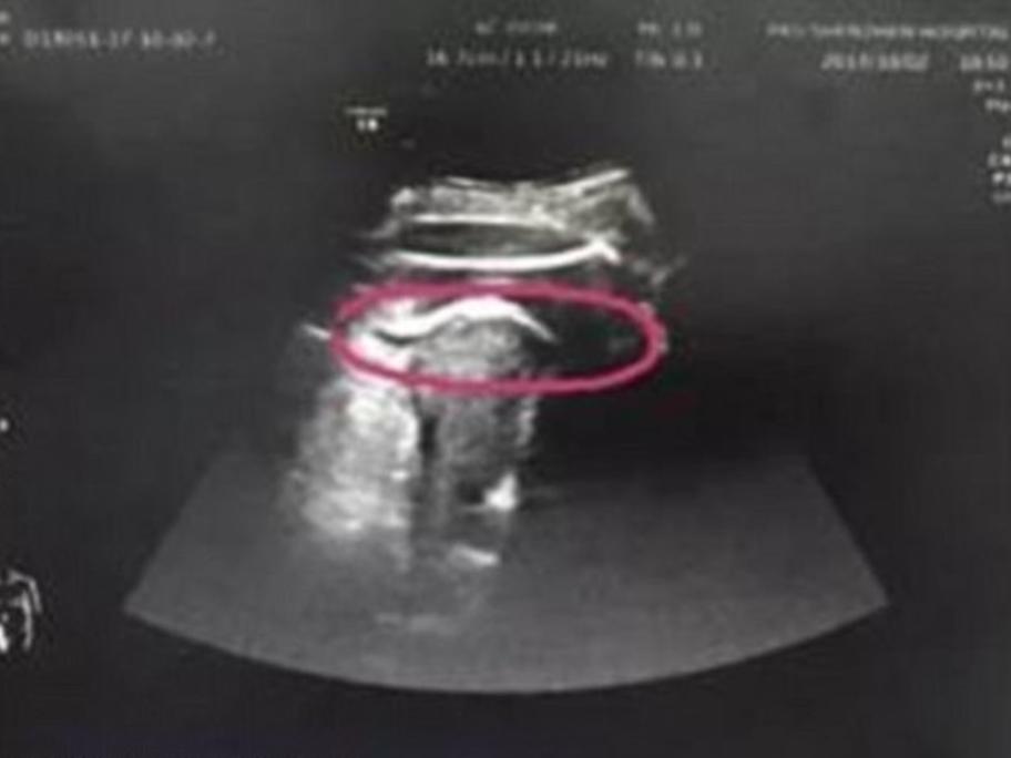 ultrasound of ruptured uterus