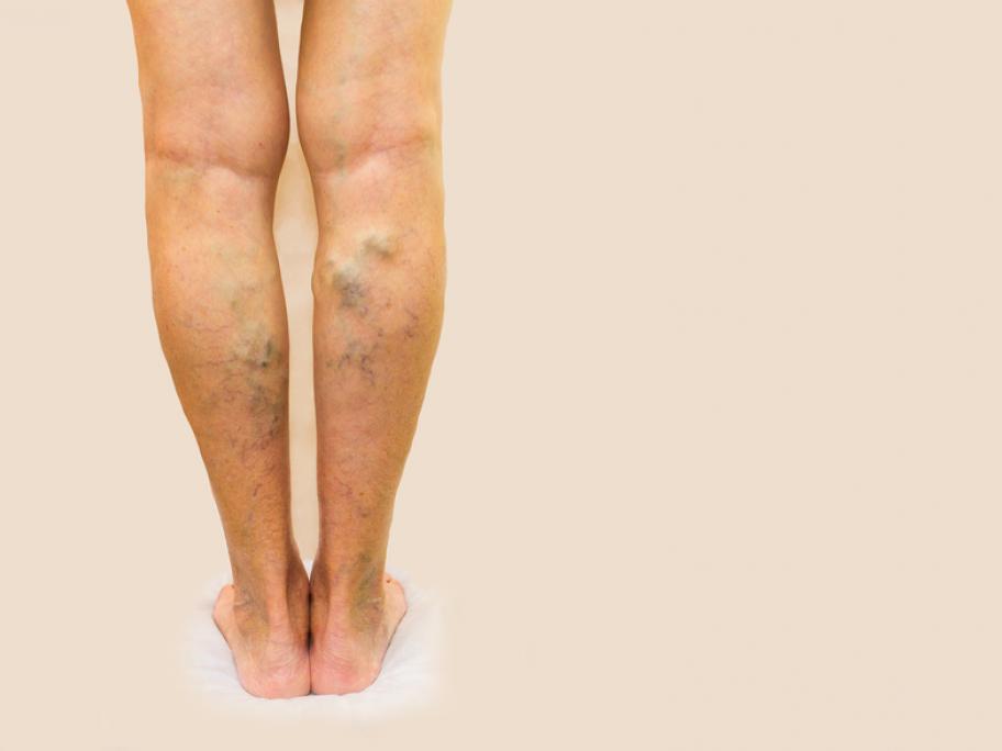 Varicose veins