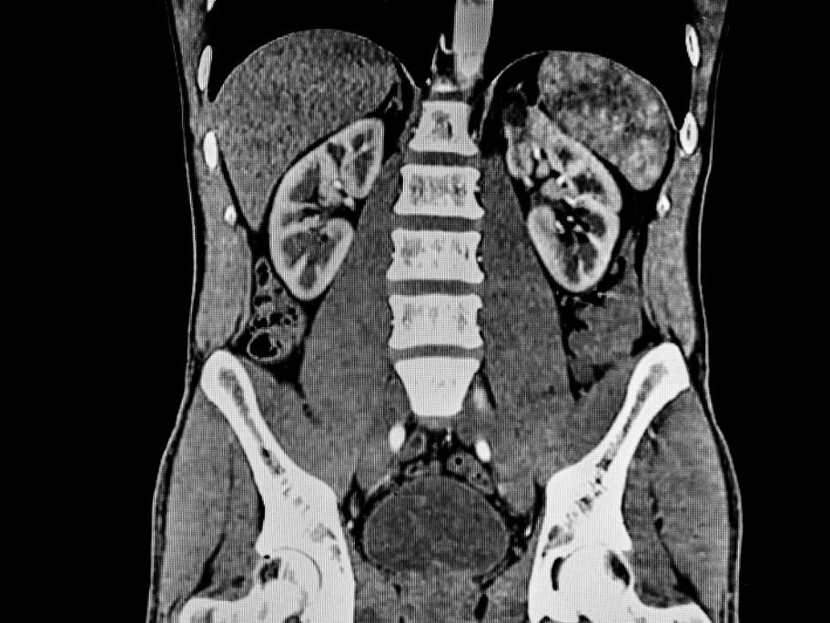 CT scan