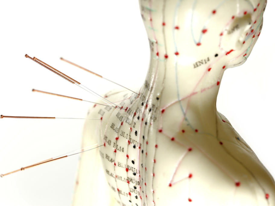 Acupuncture