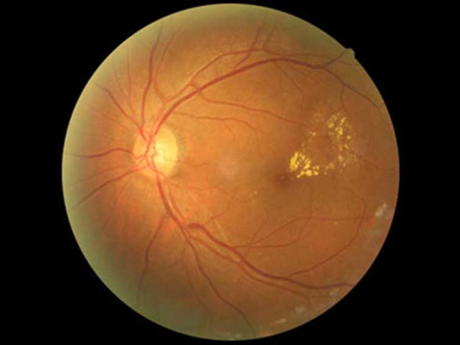 Diabetic retinopathy