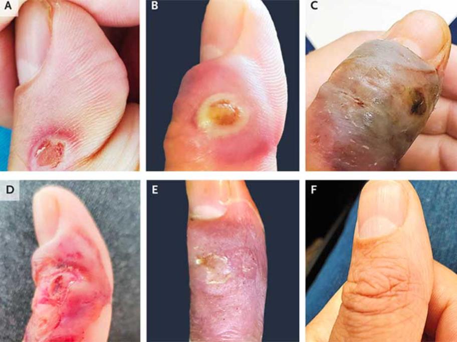 Orf infection stages