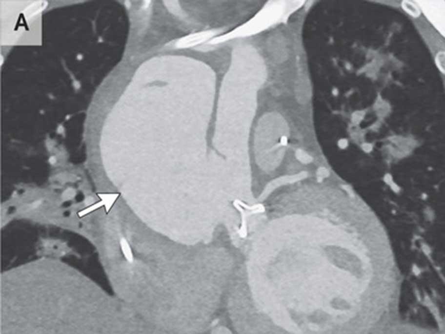 CT angiography