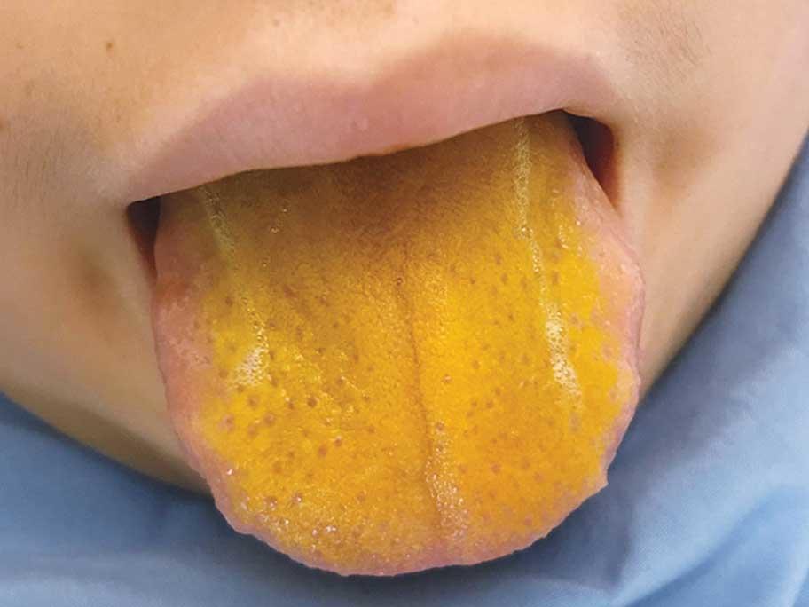 Yellow tongue