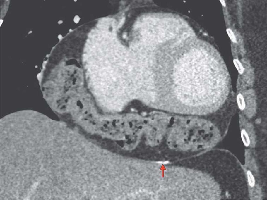 Intrapericardial colon