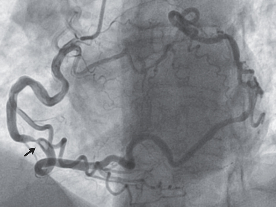 Isolated coronary artery