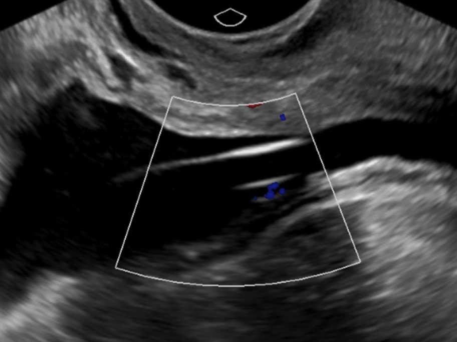 Transabdominal ultrasound