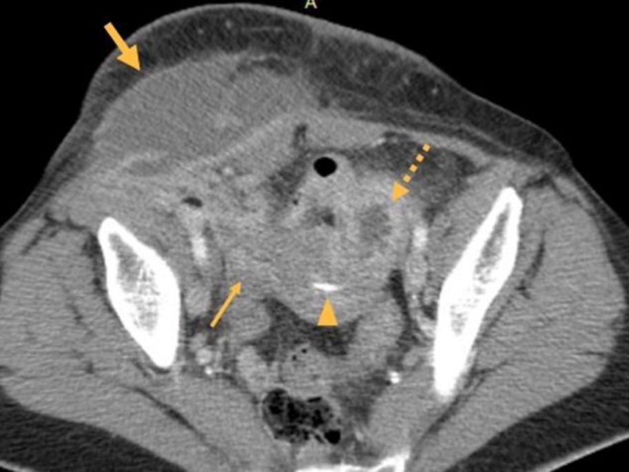 Pelvic CT