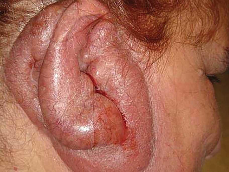 Turkey ear