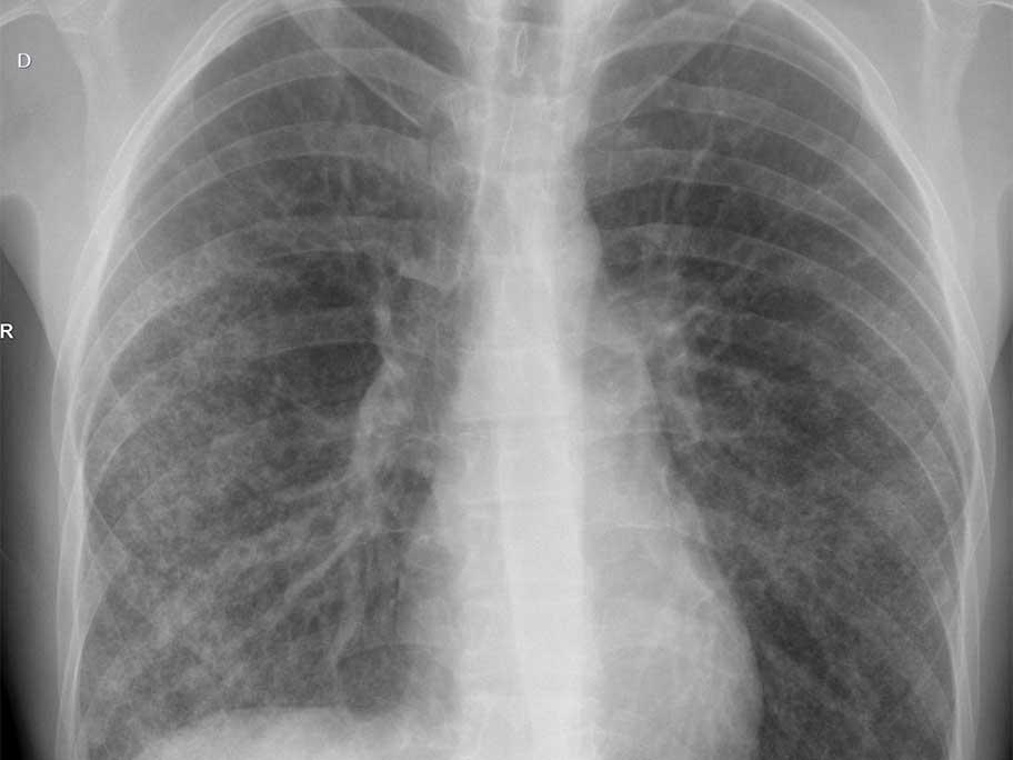 Chest X-ray