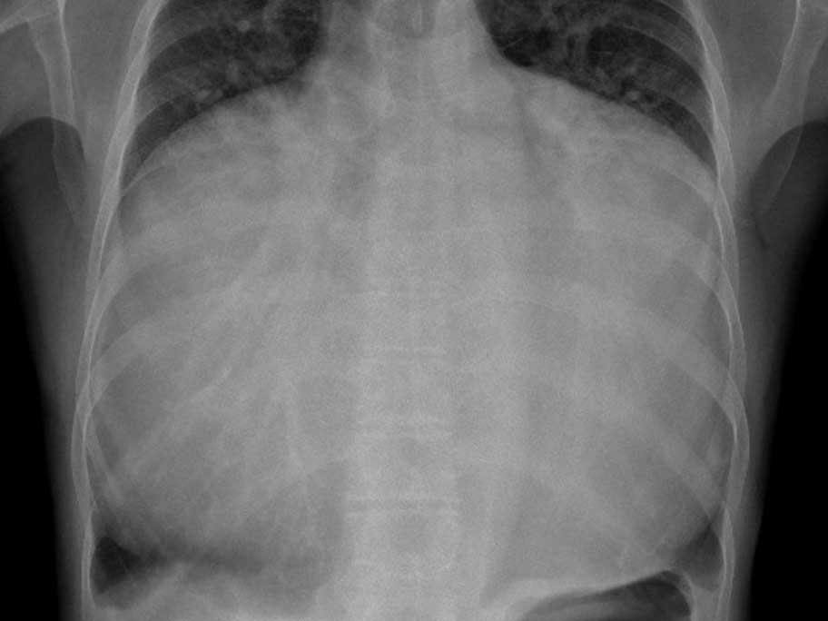Chest X-ray
