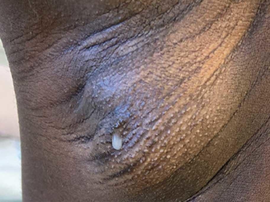 Axillary duct