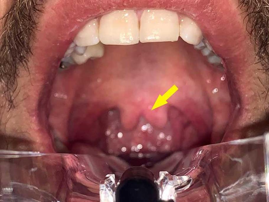 An Unexpected And Unexplained Uvula Australian Doctor Group   Must See Bifurcated Uvula NEJM 