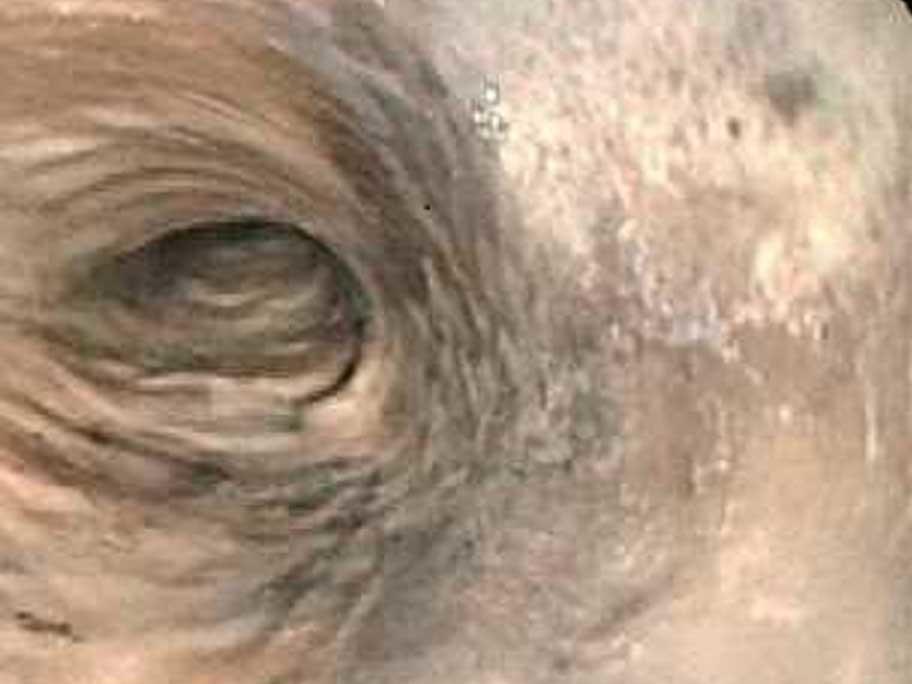 Black oesophagus