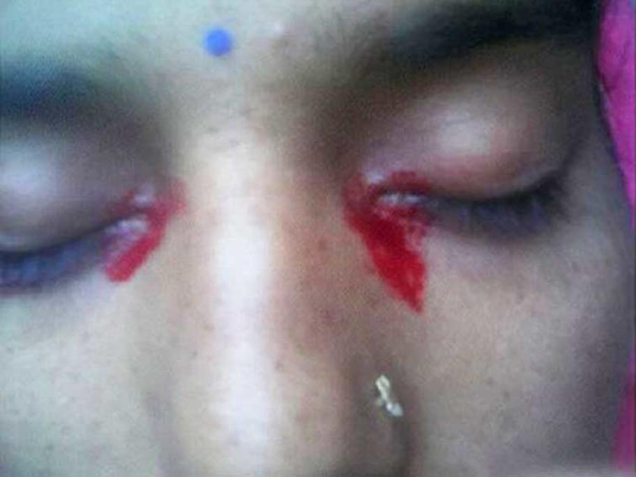 Bloody tears
