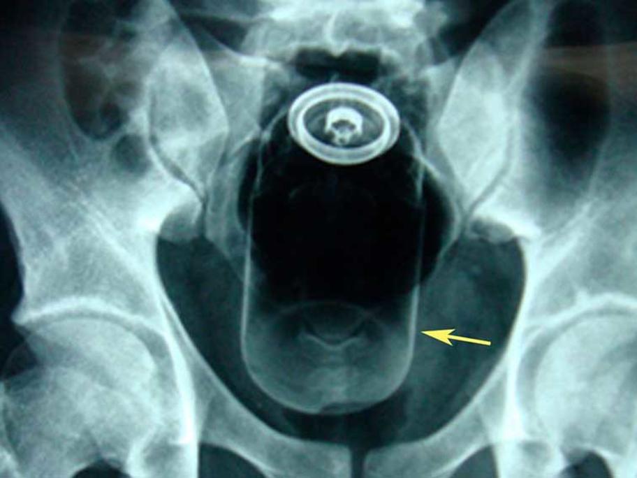 X-ray