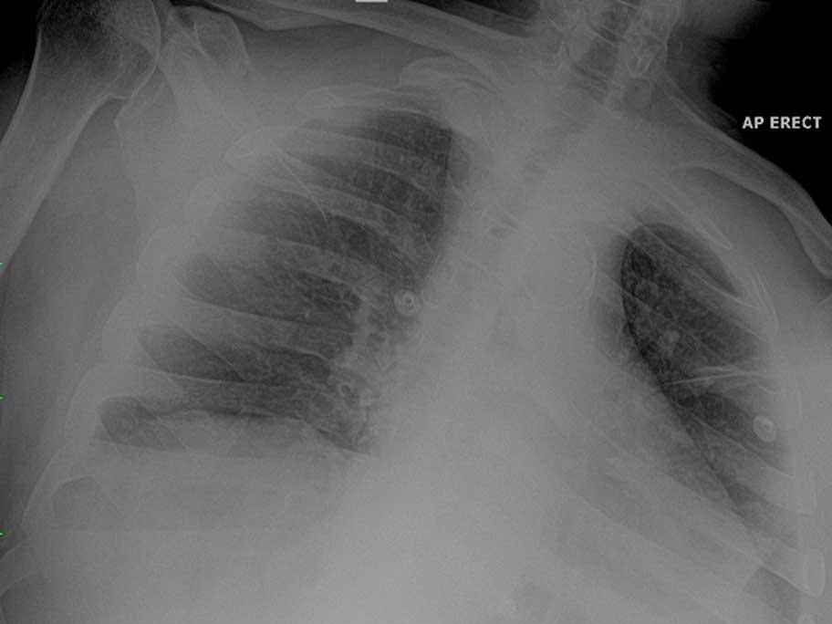 Chest X-ray