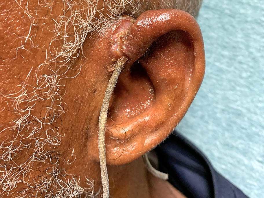 Pinna injury