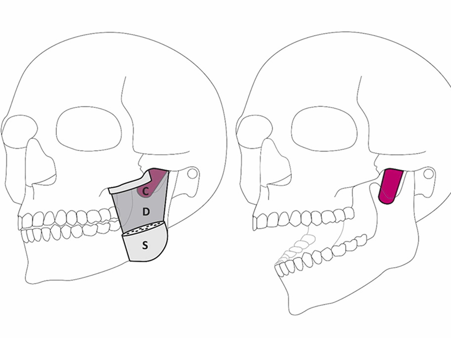 Schematic drawing of jaw muscle