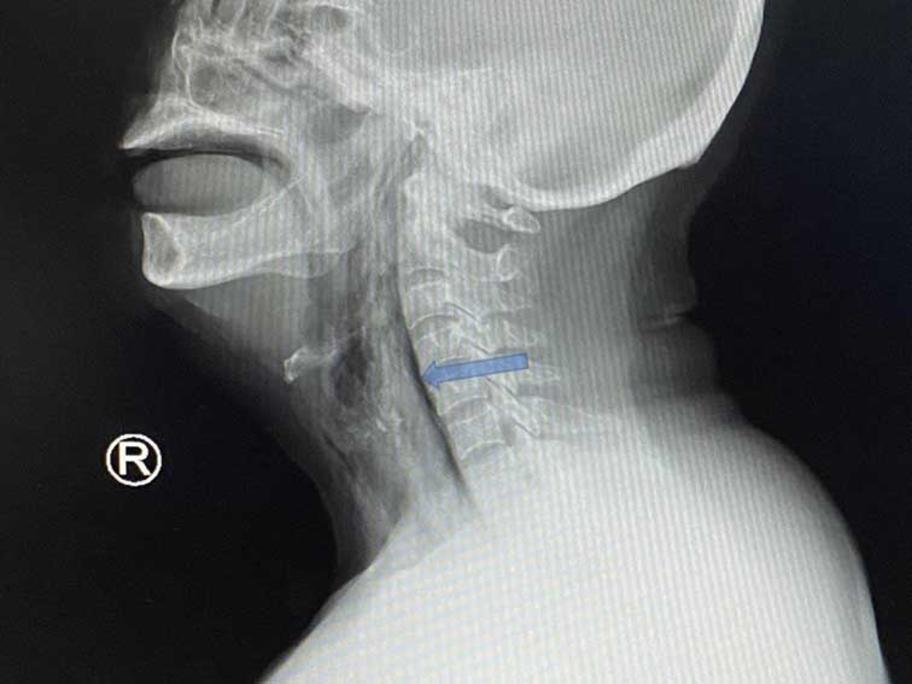 X-ray